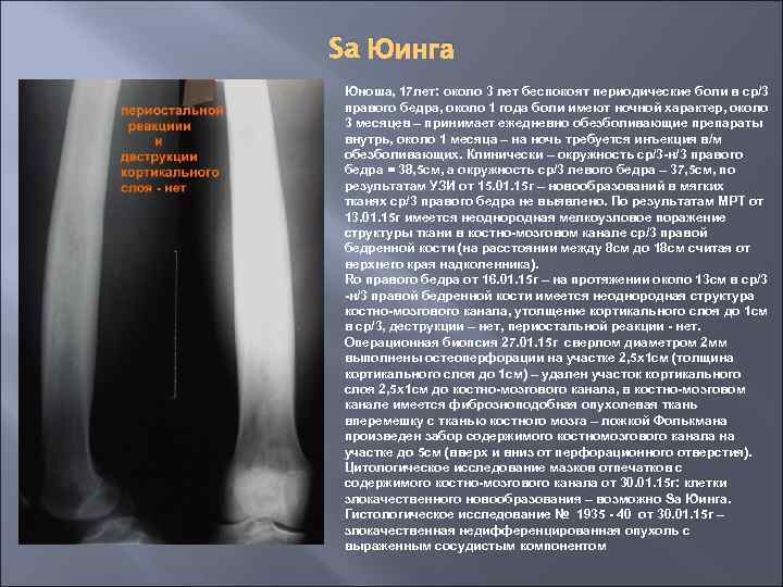 Sa Юинга Юноша, 17 лет: около 3 лет беспокоят периодические боли в ср/3 правого