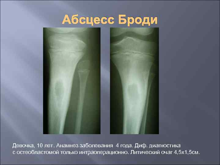 Абсцесс Броди Девочка, 10 лет. Анамнез заболевания 4 года. Диф. диагностика с остеобластомой только