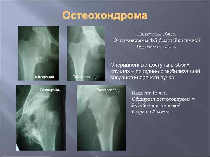 Остеохондрома Пациентка 16 лет. Остеохондрома 4 х3, 5 см шейки правой бедренной кости. до