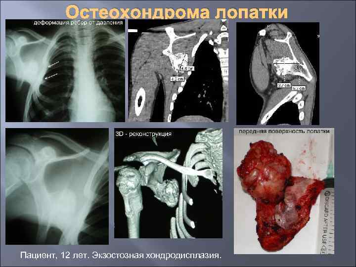 Остеохондрома лопатки Пациент, 12 лет. Экзостозная хондродисплазия. 