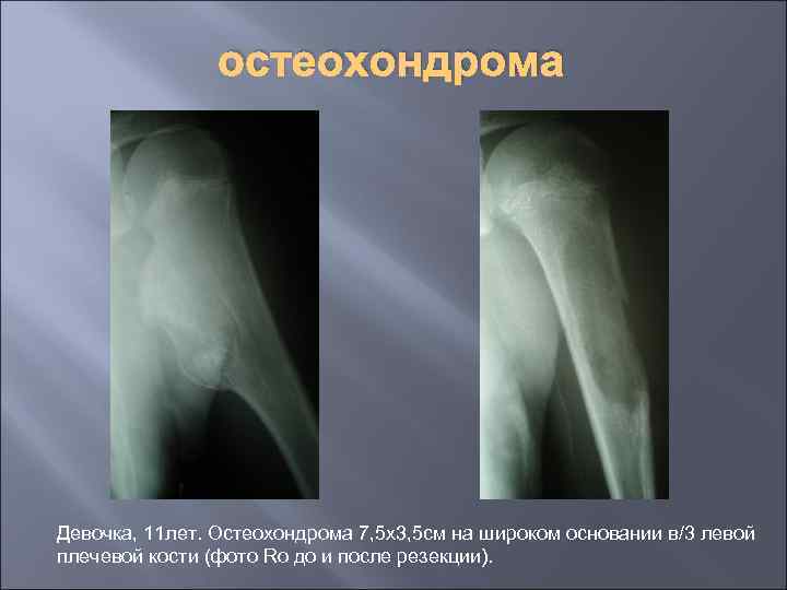 остеохондрома Девочка, 11 лет. Остеохондрома 7, 5 х3, 5 см на широком основании в/3