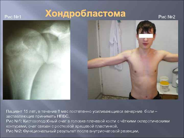 Рис № 1 Хондробластома Рис № 2 Пациент 15 лет, в течение 8 мес