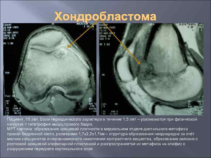 Хондробластома Пациент, 16 лет. Боли периодического характера в течение 1, 5 лет – усиливаются
