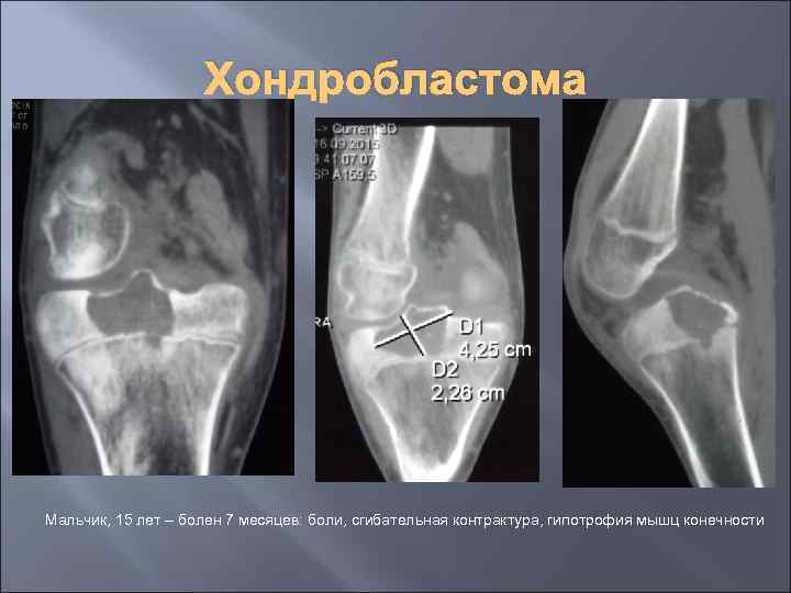 Хондробластома Мальчик, 15 лет – болен 7 месяцев: боли, сгибательная контрактура, гипотрофия мышц конечности