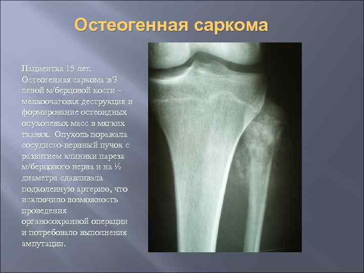 Остеогенная саркома Пациентка 15 лет. Остеогенная саркома в/3 левой м/берцовой кости – мелкоочаговая деструкция