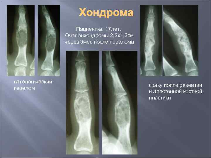 Хондрома Пациентка, 17 лет. Очаг энхондромы 2, 3 х1, 2 см через 3 мес