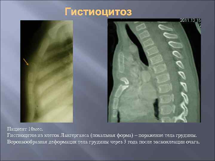 Гистиоцитоз Пациент 10 мес. Гистиоцитоз из клеток Лангерганса (локальная форма) – поражение тела грудины.
