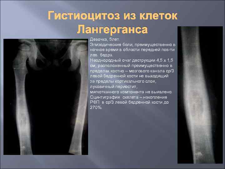 Гистиоцитоз из клеток Лангерганса Девочка, 5 лет. Эпизодические боли, преимущественно в ночное время в