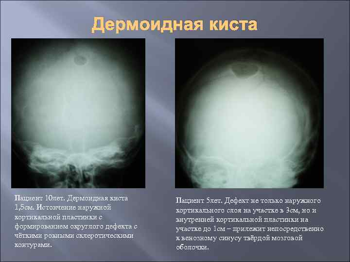 Дермоидная киста Пациент 10 лет. Дермоидная киста 1, 5 см. Истончение наружной кортикальной пластинки