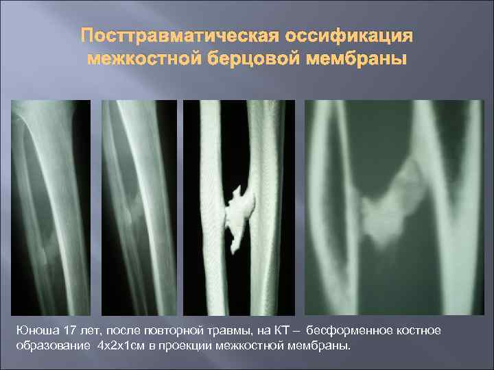 Посттравматическая оссификация межкостной берцовой мембраны Юноша 17 лет, после повторной травмы, на КТ –