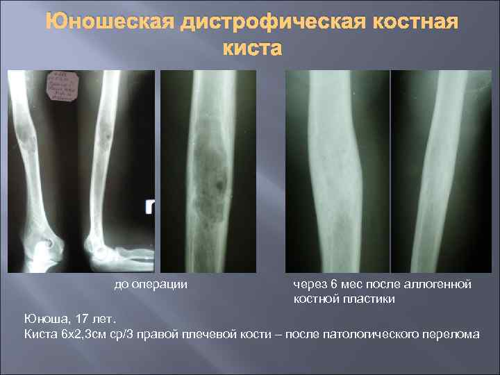 Юношеская дистрофическая костная киста до операции через 6 мес после аллогенной костной пластики Юноша,