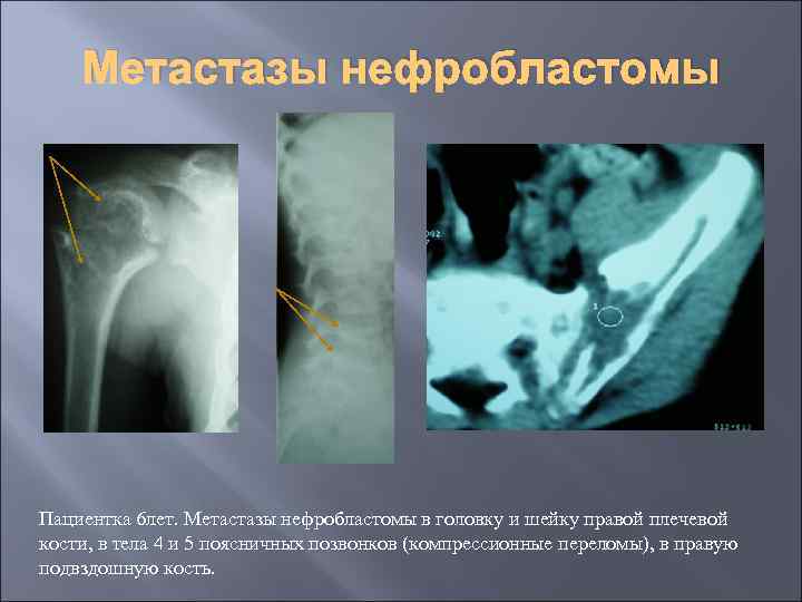 Метастазы нефробластомы Пациентка 6 лет. Метастазы нефробластомы в головку и шейку правой плечевой кости,