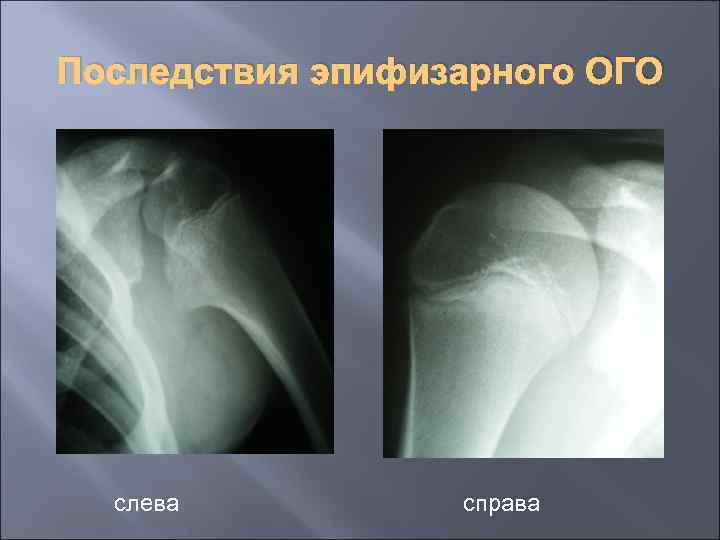 Последствия эпифизарного ОГО слева справа 