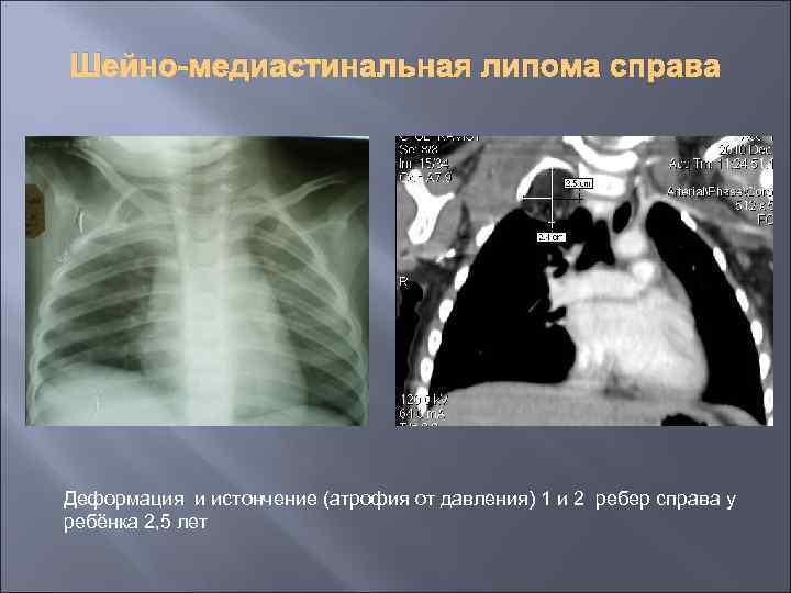 Шейно-медиастинальная липома справа Деформация и истончение (атрофия от давления) 1 и 2 ребер справа