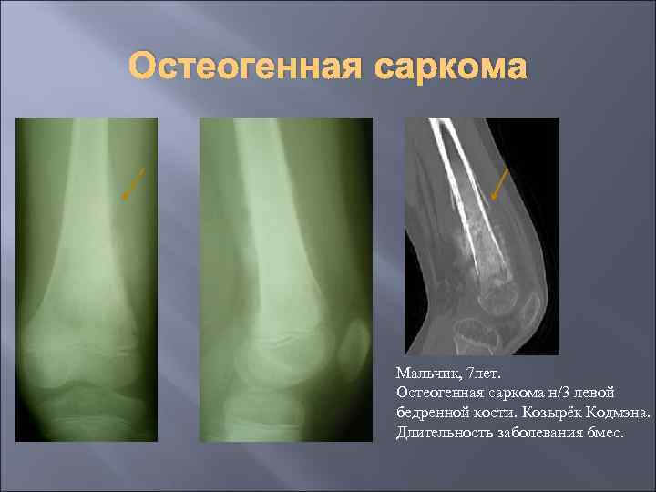 Остеогенная саркома Мальчик, 7 лет. Остеогенная саркома н/3 левой бедренной кости. Козырёк Кодмэна. Длительность