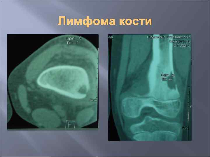 Лимфома кости 