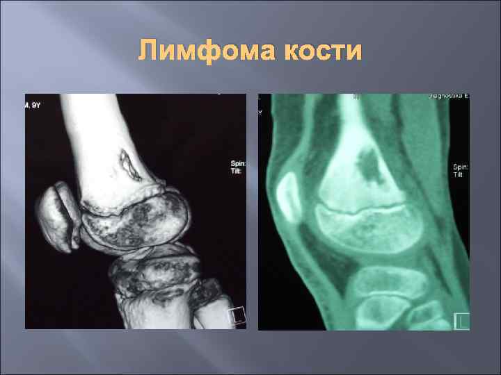 Лимфома кости 