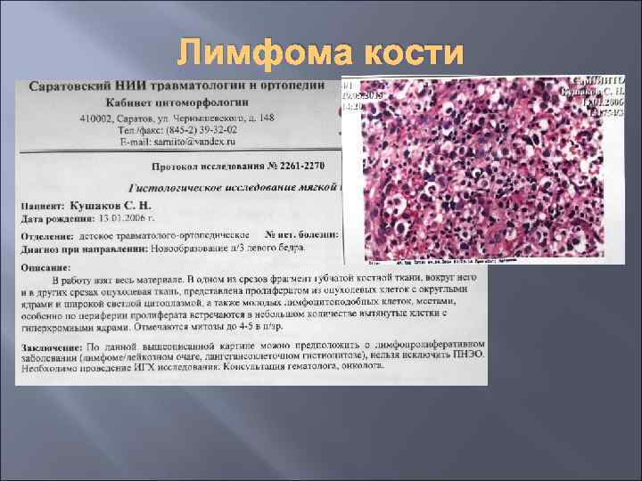 Лимфома кости 