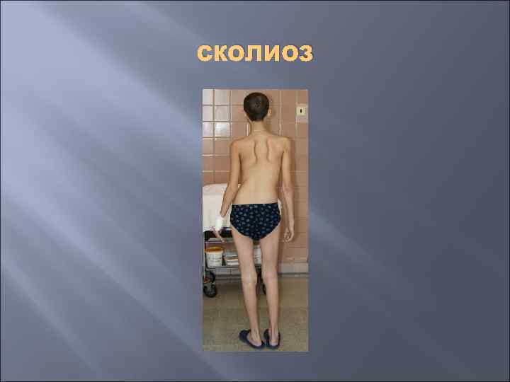 сколиоз 
