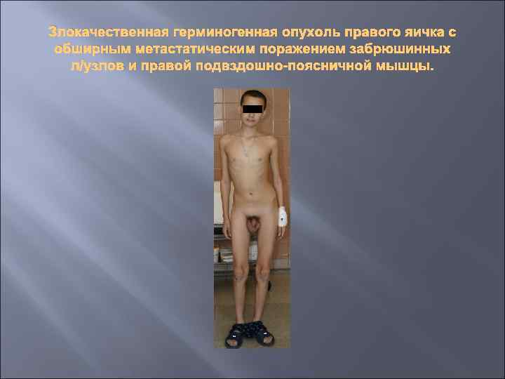 Злокачественная герминогенная опухоль правого яичка с обширным метастатическим поражением забрюшинных л/узлов и правой подвздошно-поясничной