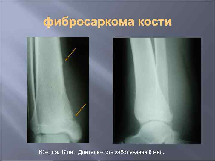 фибросаркома кости Юноша, 17 лет. Длительность заболевания 6 мес. 