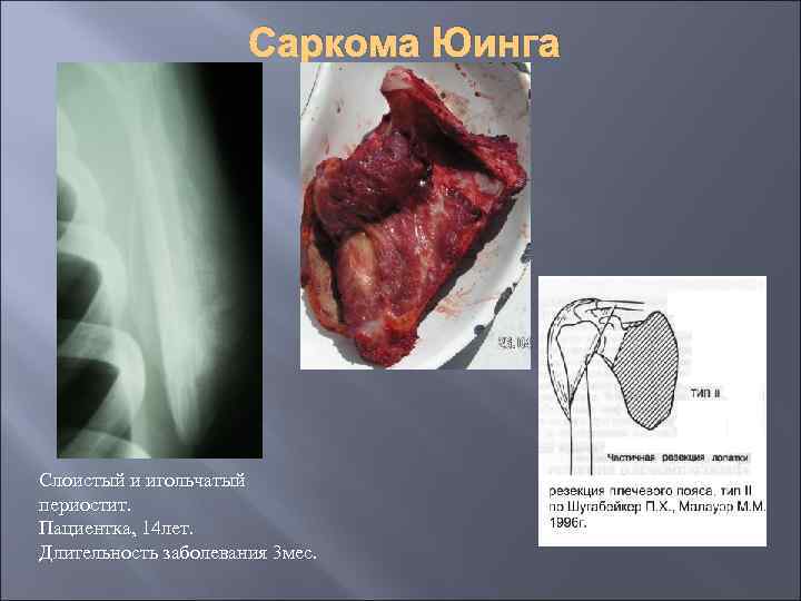 Саркома Юинга Слоистый и игольчатый периостит. Пациентка, 14 лет. Длительность заболевания 3 мес. 