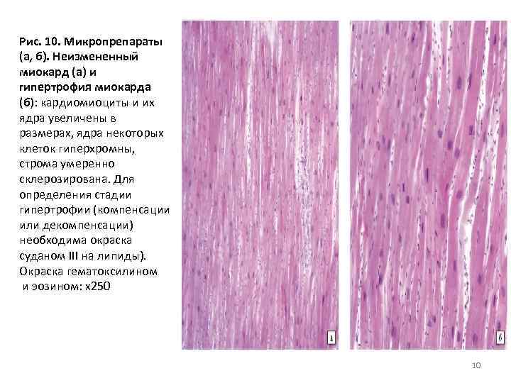 Рис. 10. Микропрепараты (а, б). Неизмененный миокард (а) и гипертрофия миокарда (б): кардиомиоциты и