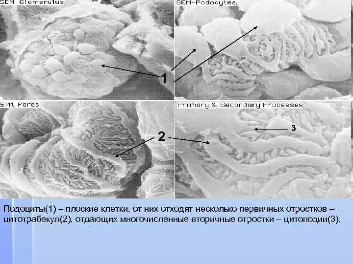 1 2 3 Подоциты(1) – плоские клетки, от них отходят несколько первичных отростков –