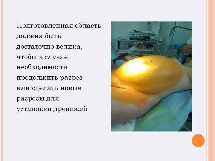 Подготовленная область должна быть достаточно велика, чтобы в случае необходимости продолжить разрез или сделать