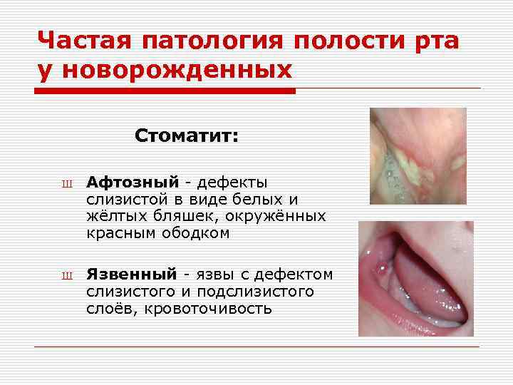 Частая патология полости рта у новорожденных Стоматит: Ш Ш Афтозный - дефекты слизистой в