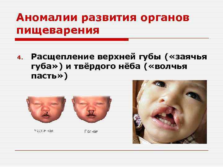 Аномалии развития органов пищеварения 4. Расщепление верхней губы ( «заячья губа» ) и твёрдого