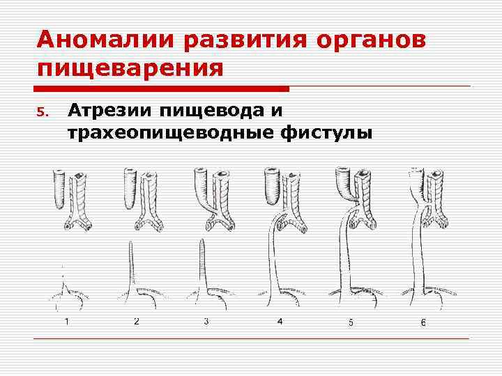 Аномалии развития органов пищеварения 5. Атрезии пищевода и трахеопищеводные фистулы 