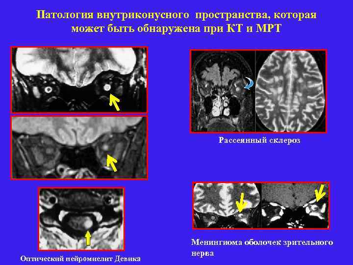 Патология внутриконусного пространства, которая может быть обнаружена при КТ и МРТ Рассеянный склероз Оптический