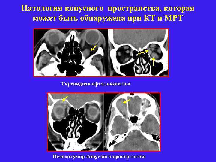 Патология конусного пространства, которая может быть обнаружена при КТ и МРТ Тиреоидная офтальмопатия Псевдотумор
