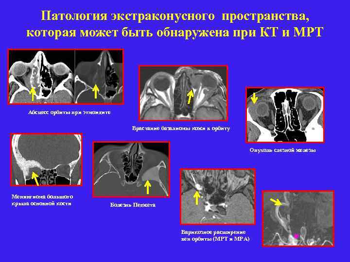 Патология экстраконусного пространства, которая может быть обнаружена при КТ и МРТ Абсцесс орбиты при