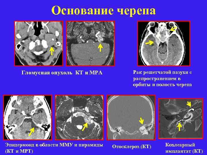 Основание черепа Гломусная опухоль КТ и МРА Эпидермоид в области ММУ и пирамиды (КТ