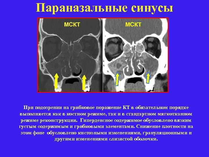 Параназальные синусы МСКТ При подозрении на грибковое поражение КТ в обязательном порядке выполняется как