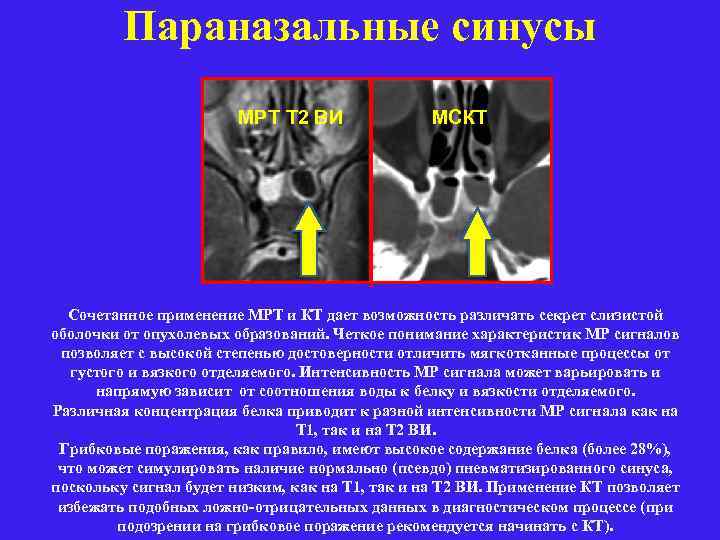 Параназальные синусы МРТ Т 2 ВИ МСКТ Сочетанное применение МРТ и КТ дает возможность