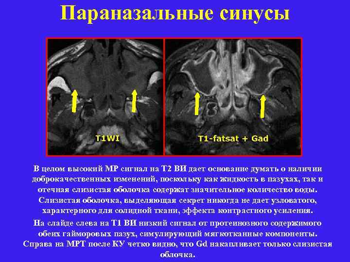 Параназальные синусы В целом высокий МР сигнал на Т 2 ВИ дает основание думать