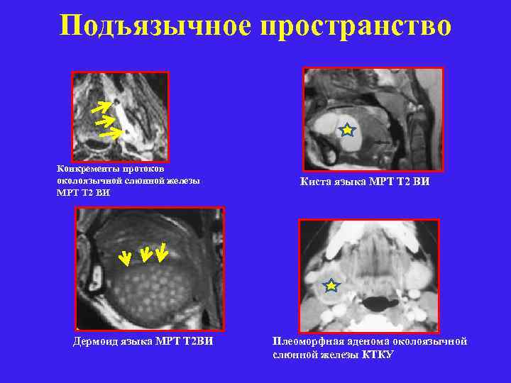 Подъязычное пространство Конкременты протоков околоязычной слюнной железы МРТ Т 2 ВИ Дермоид языка МРТ