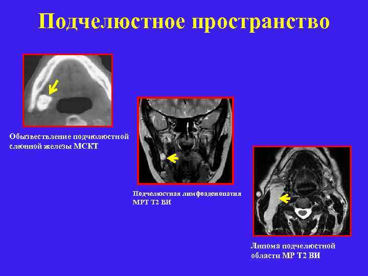 Подчелюстное пространство Обызвествление подчюлюстной слюнной железы МСКТ Подчелюстная лимфоаденопатия МРТ Т 2 ВИ Липома