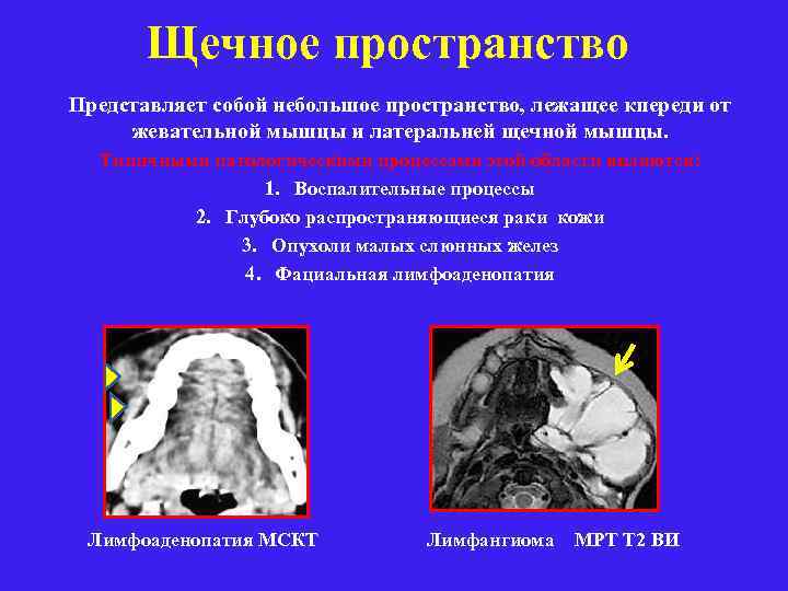 Щечное пространство Представляет собой небольшое пространство, лежащее кпереди от жевательной мышцы и латеральней щечной