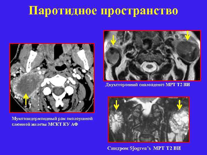 Паротидное пространство Двухсторонний сиалоаденоз МРТ Т 2 ВИ Мукоэпидермоидный рак околоушной слюнной железы МСКТ