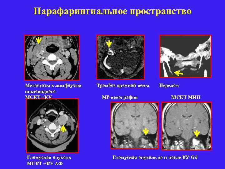 Парафарингиальное пространство Метастазы в лимфоузлы Тромбоз яремной вены Перелом шиловидного МСКТ +КУ МР венография