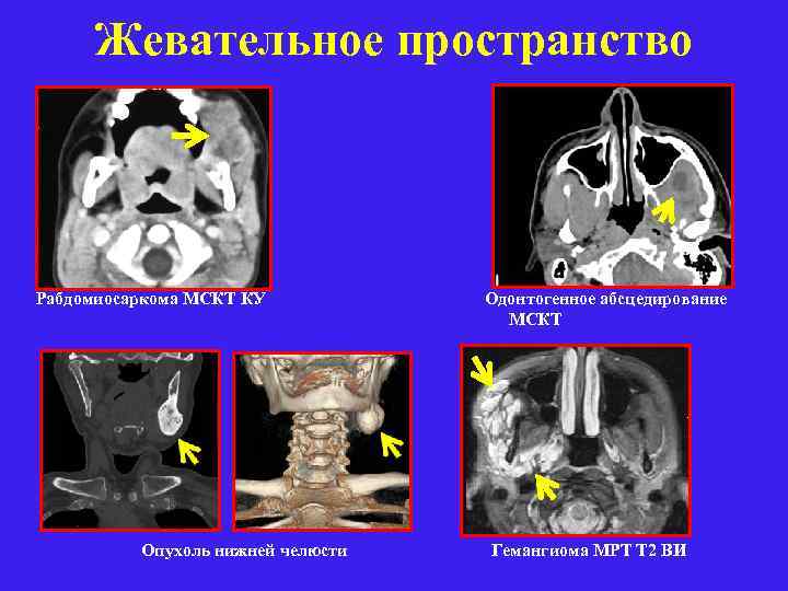 Жевательное пространство Рабдомиосаркома МСКТ КУ Одонтогенное абсцедирование МСКТ Опухоль нижней челюсти Гемангиома МРТ Т