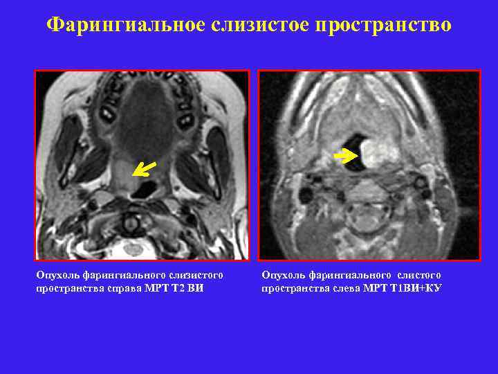 Фарингиальное слизистое пространство Опухоль фарингиального слизистого пространства справа МРТ Т 2 ВИ Опухоль фарингиального