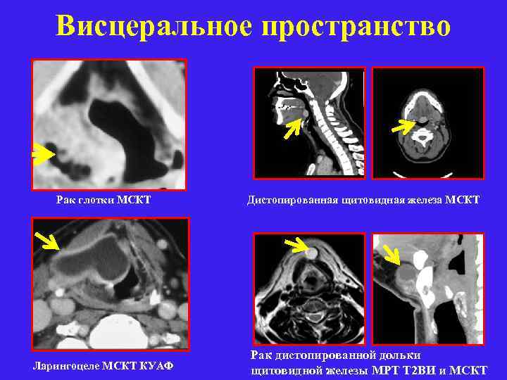 Висцеральное пространство Рак глотки МСКТ Дистопированная щитовидная железа МСКТ Ларингоцеле МСКТ КУАФ Рак дистопированной
