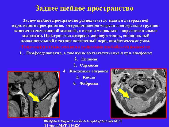 Заднее шейное пространство располагается кзади и латеральней каротидного пространства, отграничивается спереди и латерально грудиноключично-сосцевидной