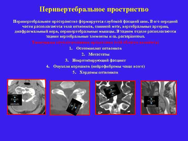 Перивертебральное прострнство Перивертебральное пространство формируется глубокой фасцией шеи. В его передней части располагаются тела