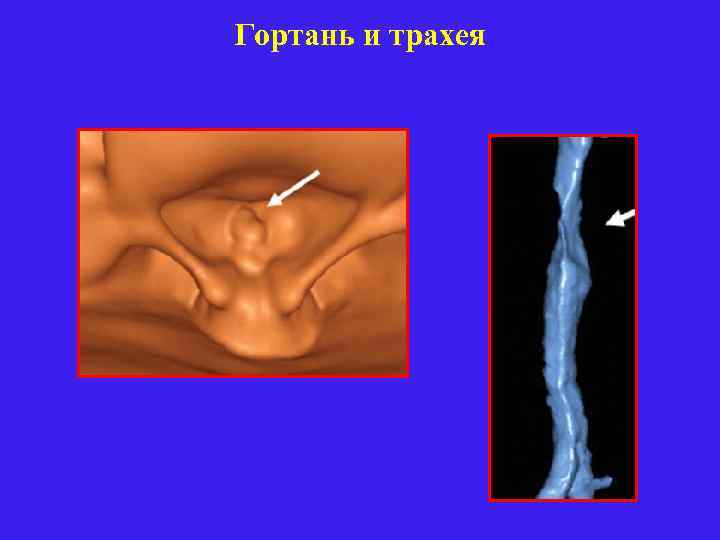 Гортань и трахея 